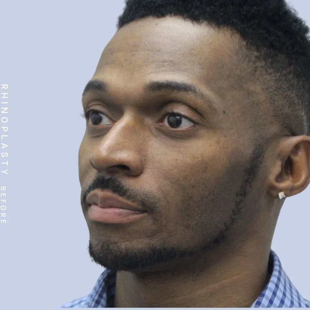 Men's Nose Before & After Gallery - Patient 120868322 - Image 3