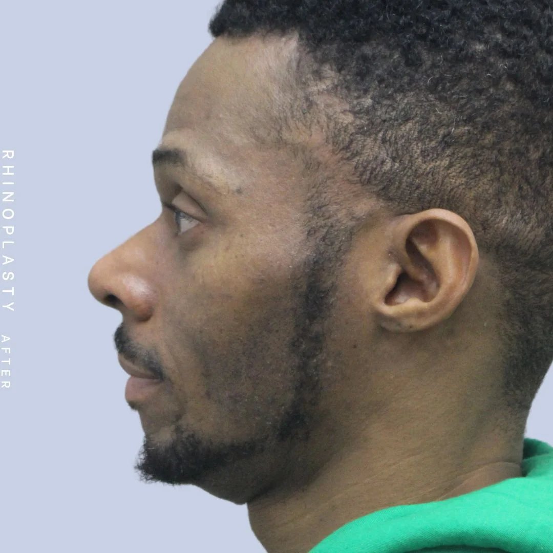 Men's Nose Before & After Gallery - Patient 120868322 - Image 6