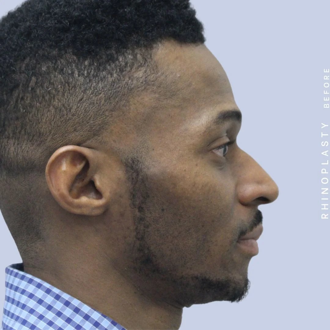 Men's Nose Before & After Gallery - Patient 120868322 - Image 7