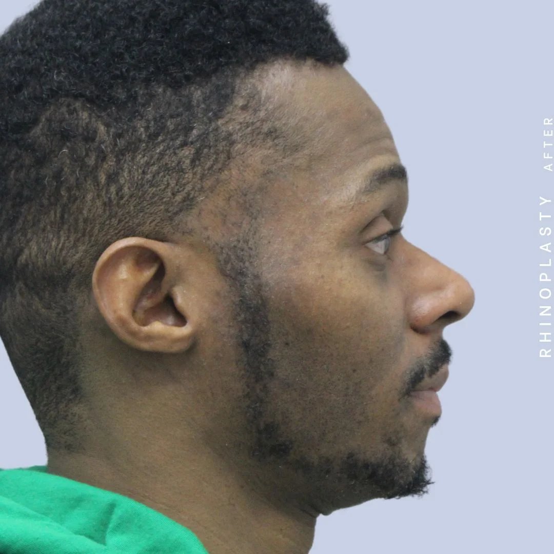 Men's Nose Before & After Gallery - Patient 120868322 - Image 8