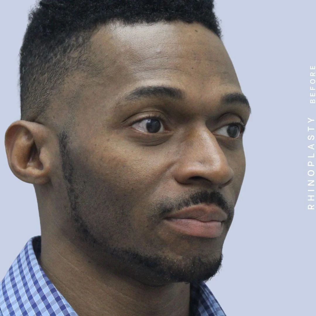 Men's Nose Before & After Gallery - Patient 120868322 - Image 9