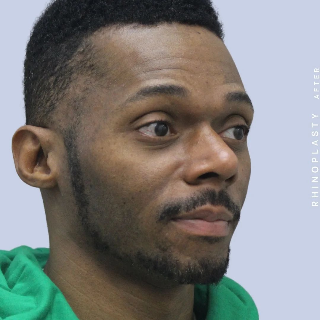 Men's Nose Before & After Gallery - Patient 120868322 - Image 10