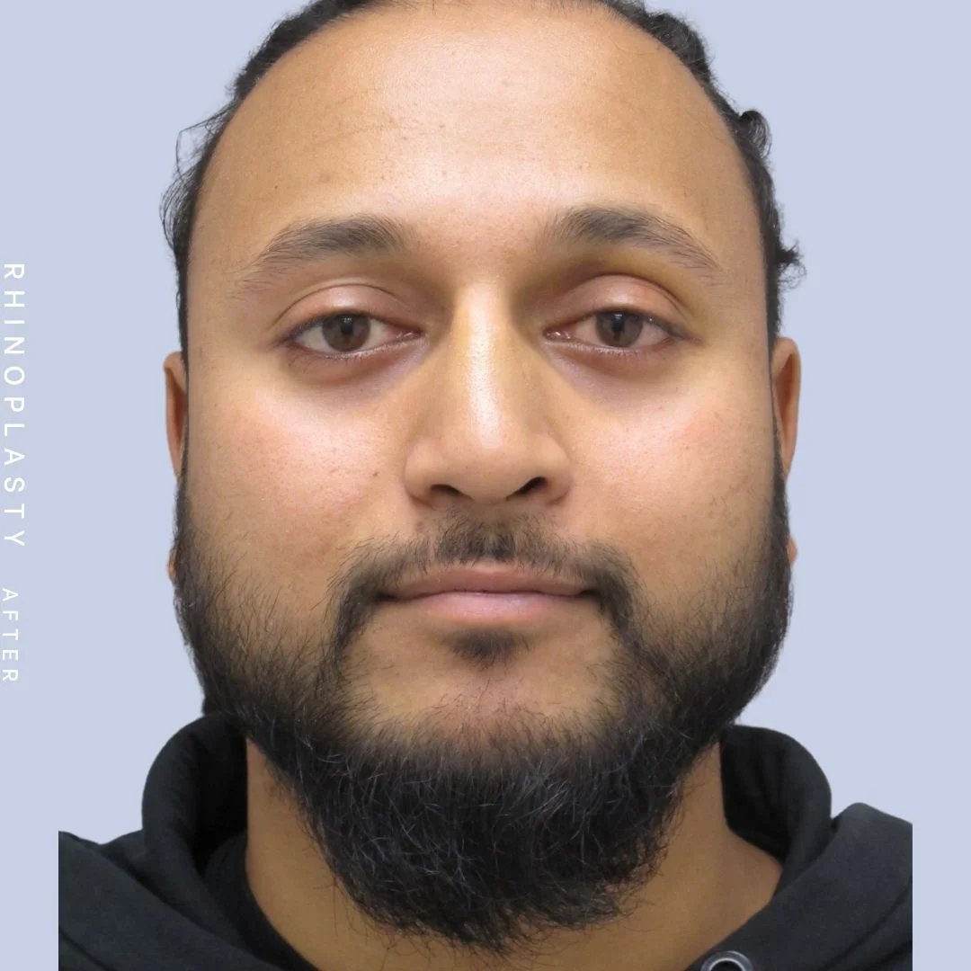 Men's Nose Before & After Gallery - Patient 120868331 - Image 2