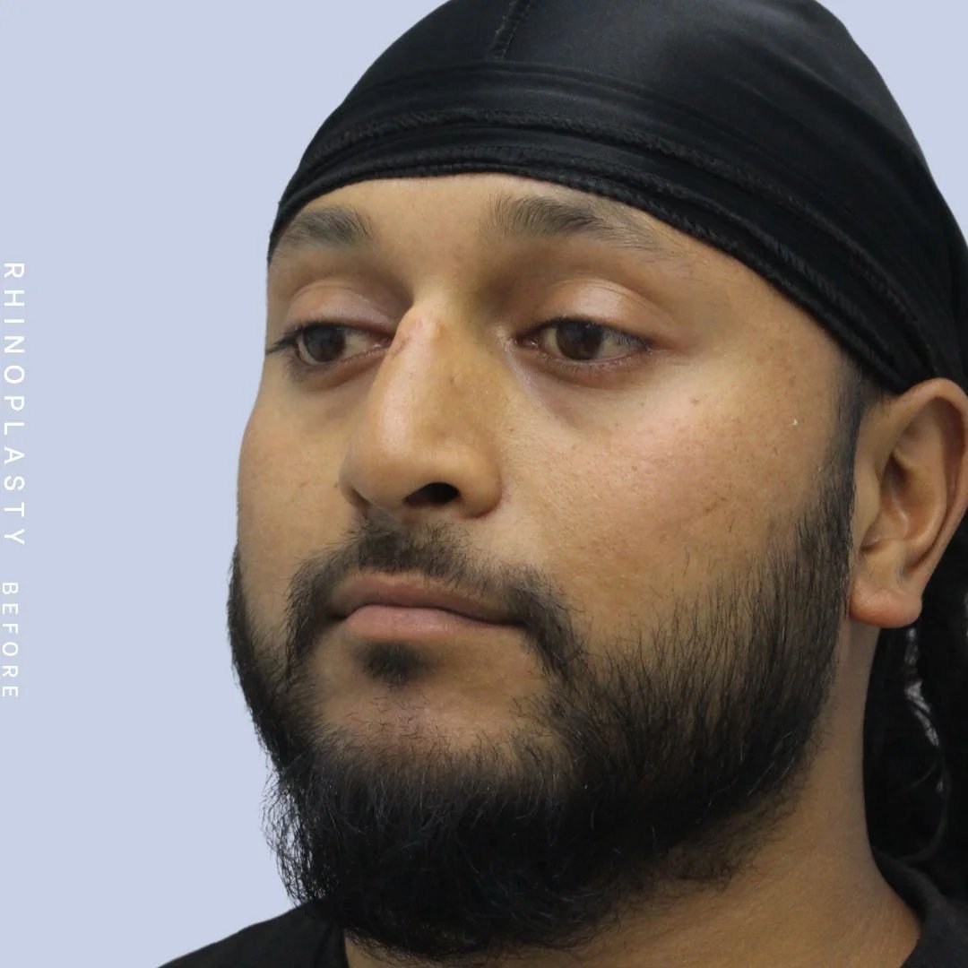 Men's Nose Before & After Gallery - Patient 120868331 - Image 3