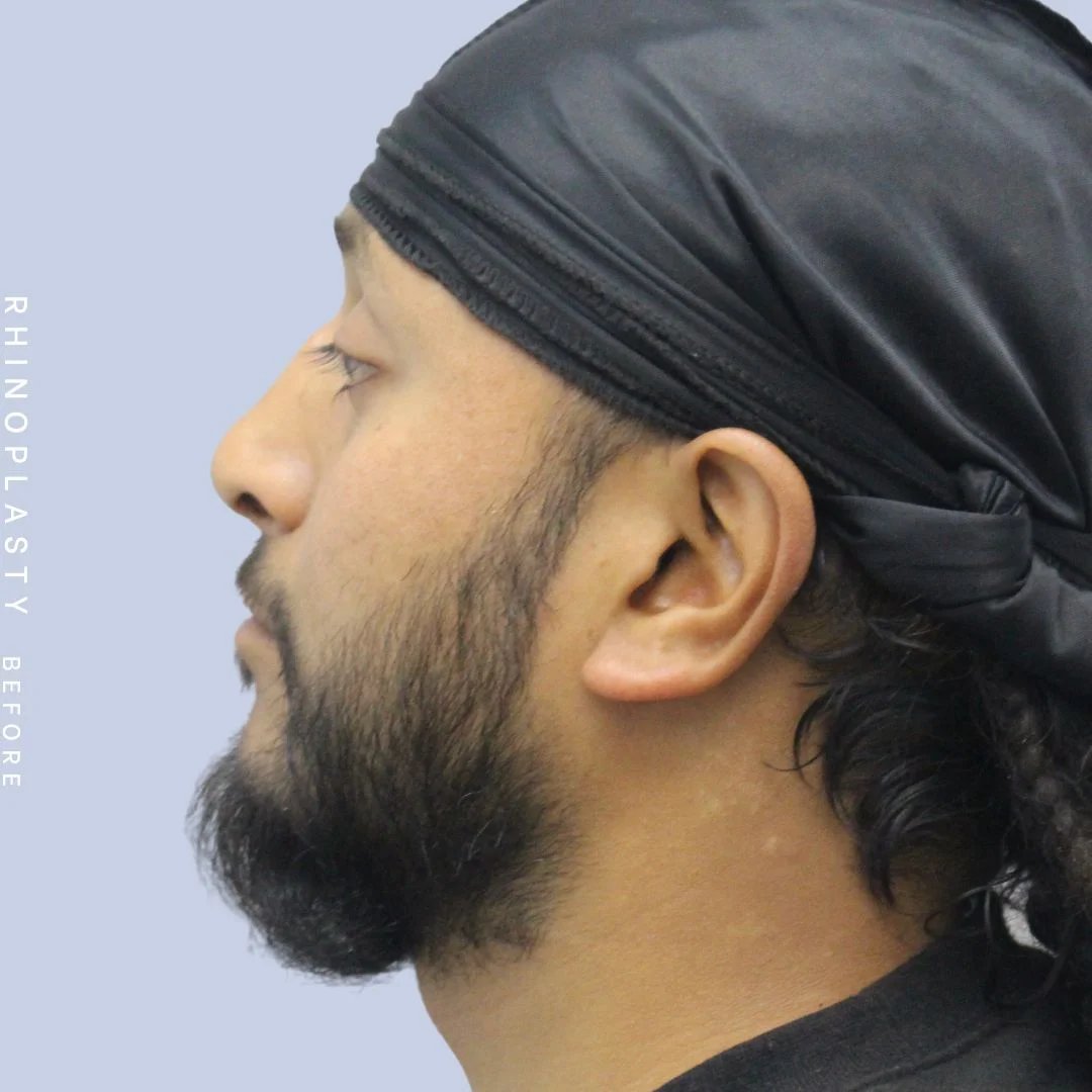 Men's Nose Before & After Gallery - Patient 120868331 - Image 5