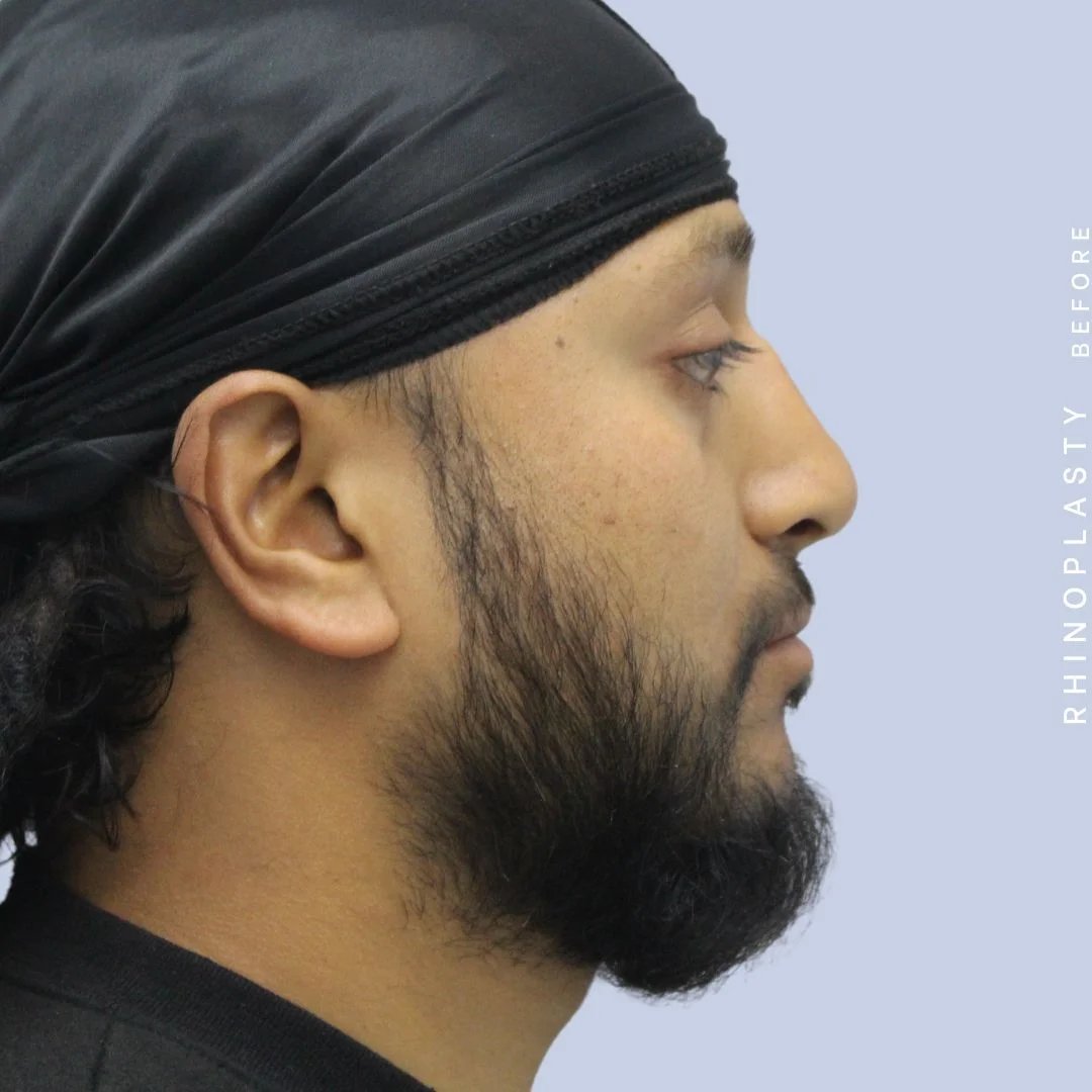 Men's Nose Before & After Gallery - Patient 120868331 - Image 7