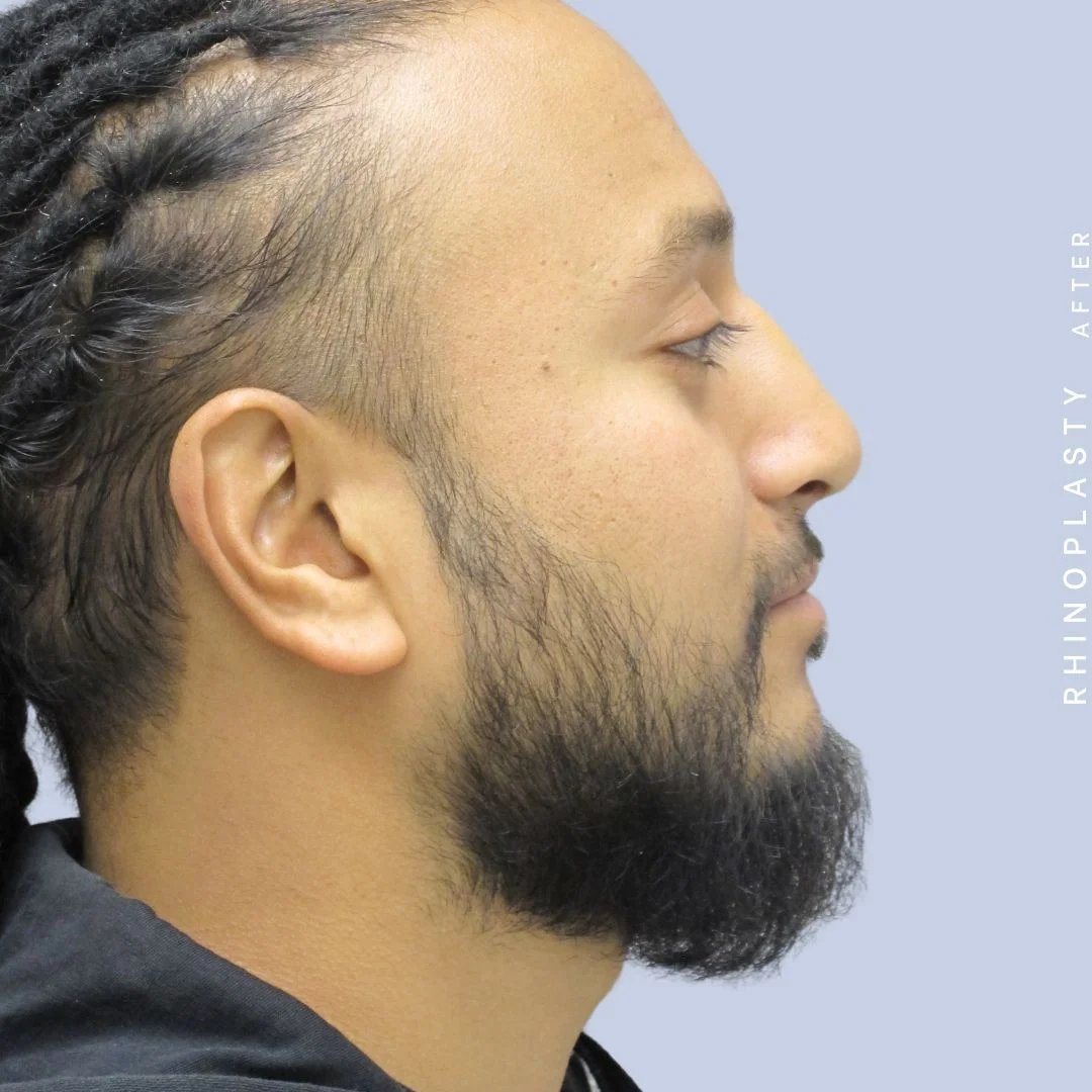 Men's Nose Before & After Gallery - Patient 120868331 - Image 8