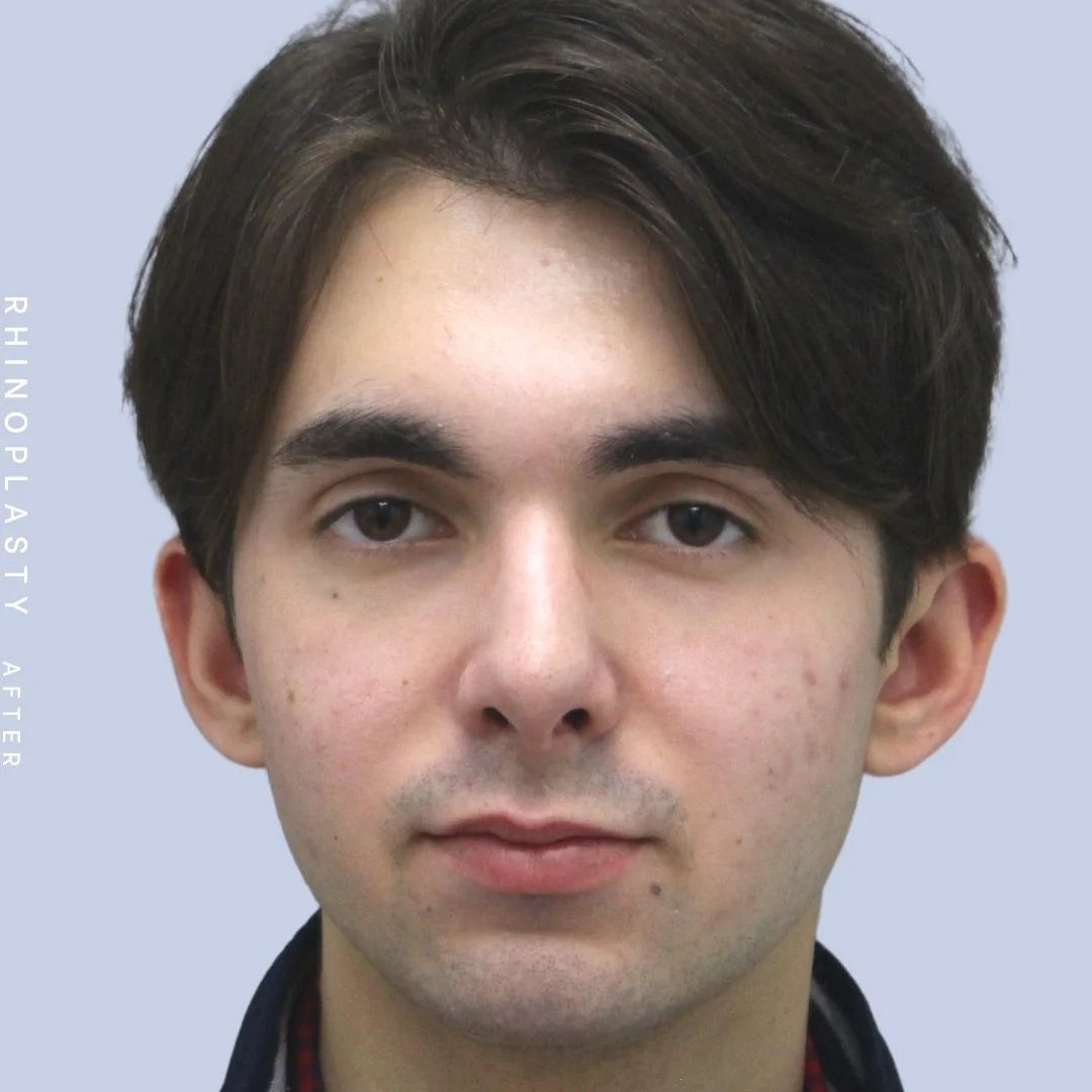 Men's Nose Before & After Gallery - Patient 120868387 - Image 2