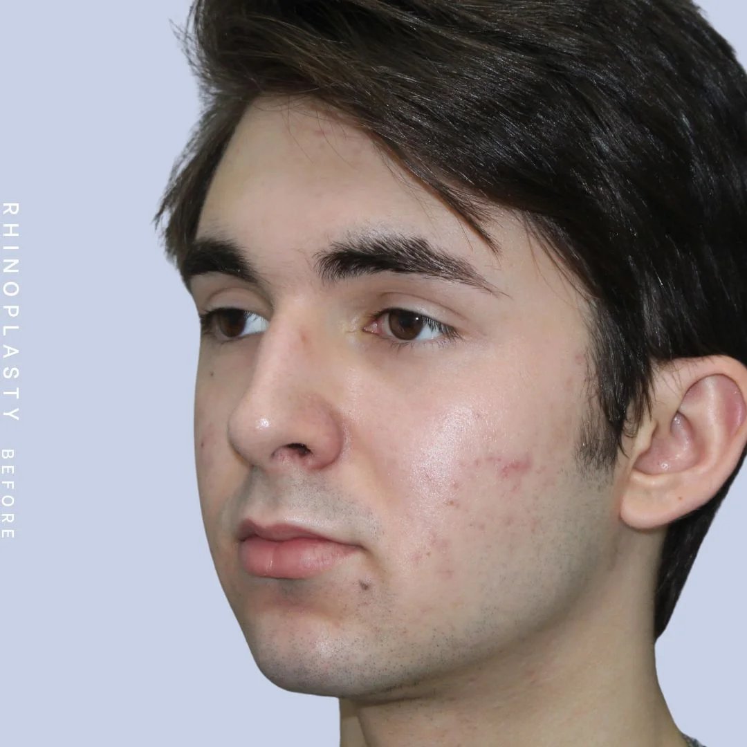 Men's Nose Before & After Gallery - Patient 120868387 - Image 3
