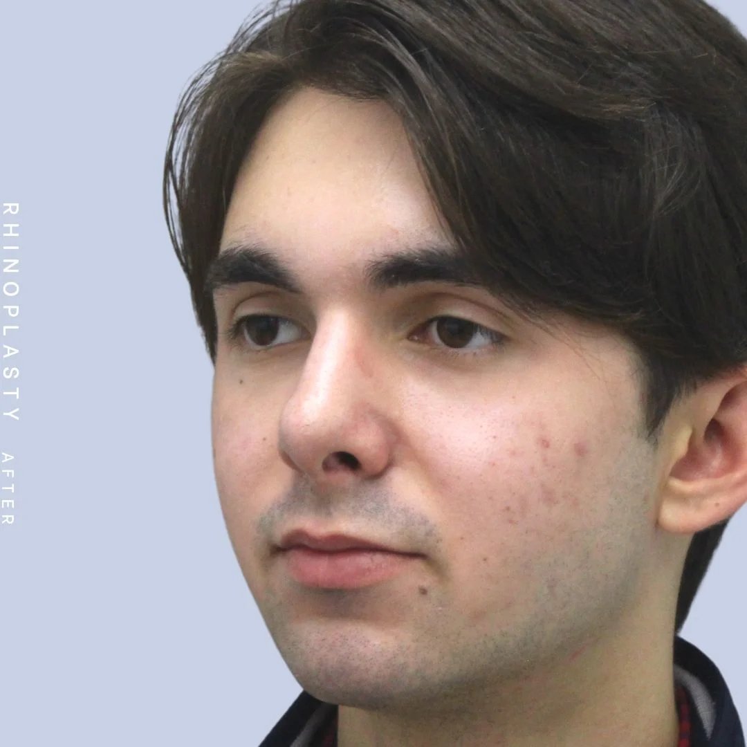 Men's Nose Before & After Gallery - Patient 120868387 - Image 4