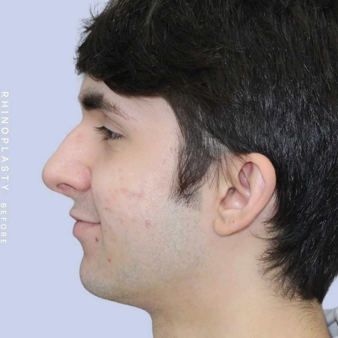 Men's Nose Before & After Gallery - Patient 120868387 - Image 5