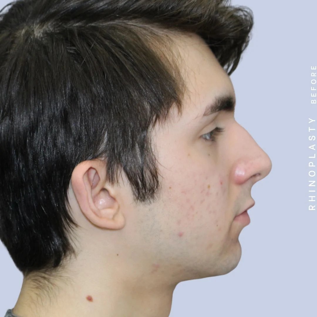 Men's Nose Before & After Gallery - Patient 120868387 - Image 7