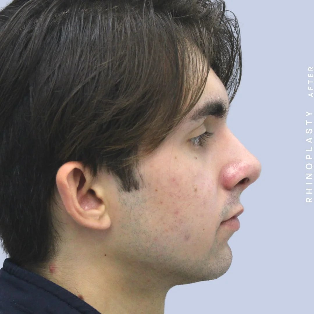 Men's Nose Before & After Gallery - Patient 120868387 - Image 8