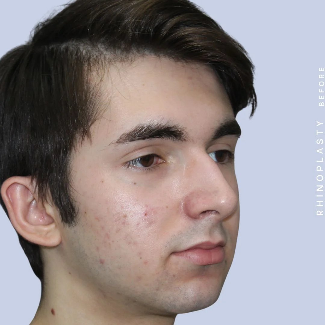 Men's Nose Before & After Gallery - Patient 120868387 - Image 9