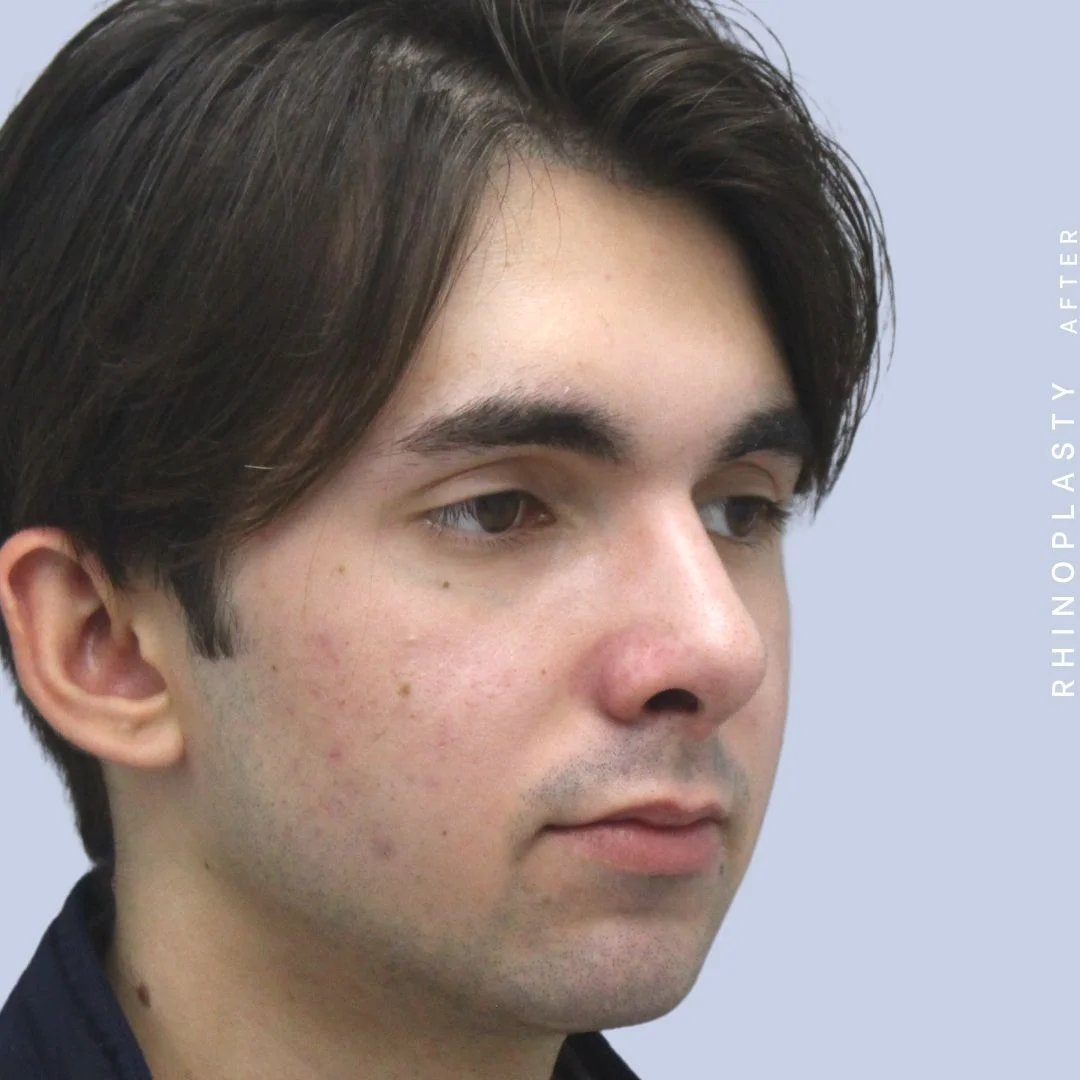 Men's Nose Before & After Gallery - Patient 120868387 - Image 10