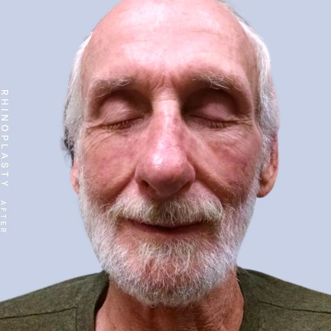 Men's Nose Before & After Gallery - Patient 121123753 - Image 2