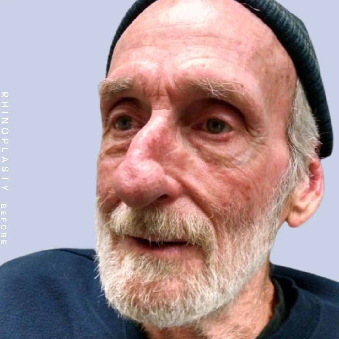 Men's Nose Before & After Gallery - Patient 121123753 - Image 3
