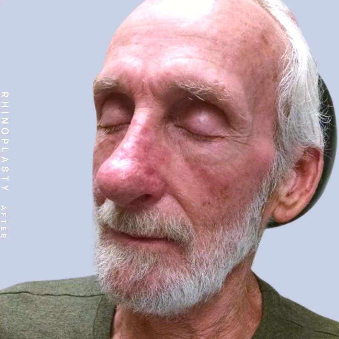 Men's Nose Before & After Gallery - Patient 121123753 - Image 4