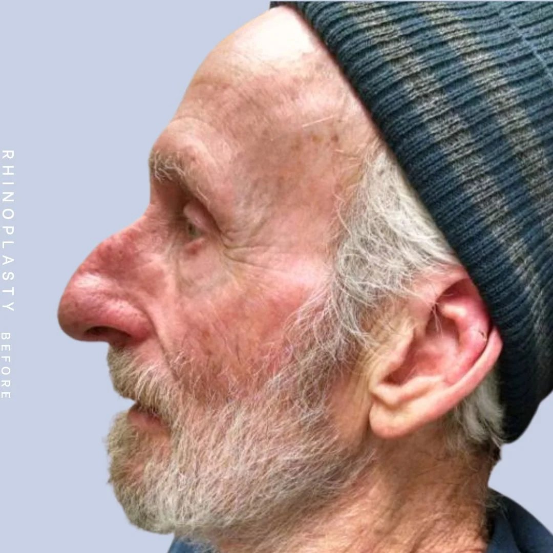 Men's Nose Before & After Gallery - Patient 121123753 - Image 5