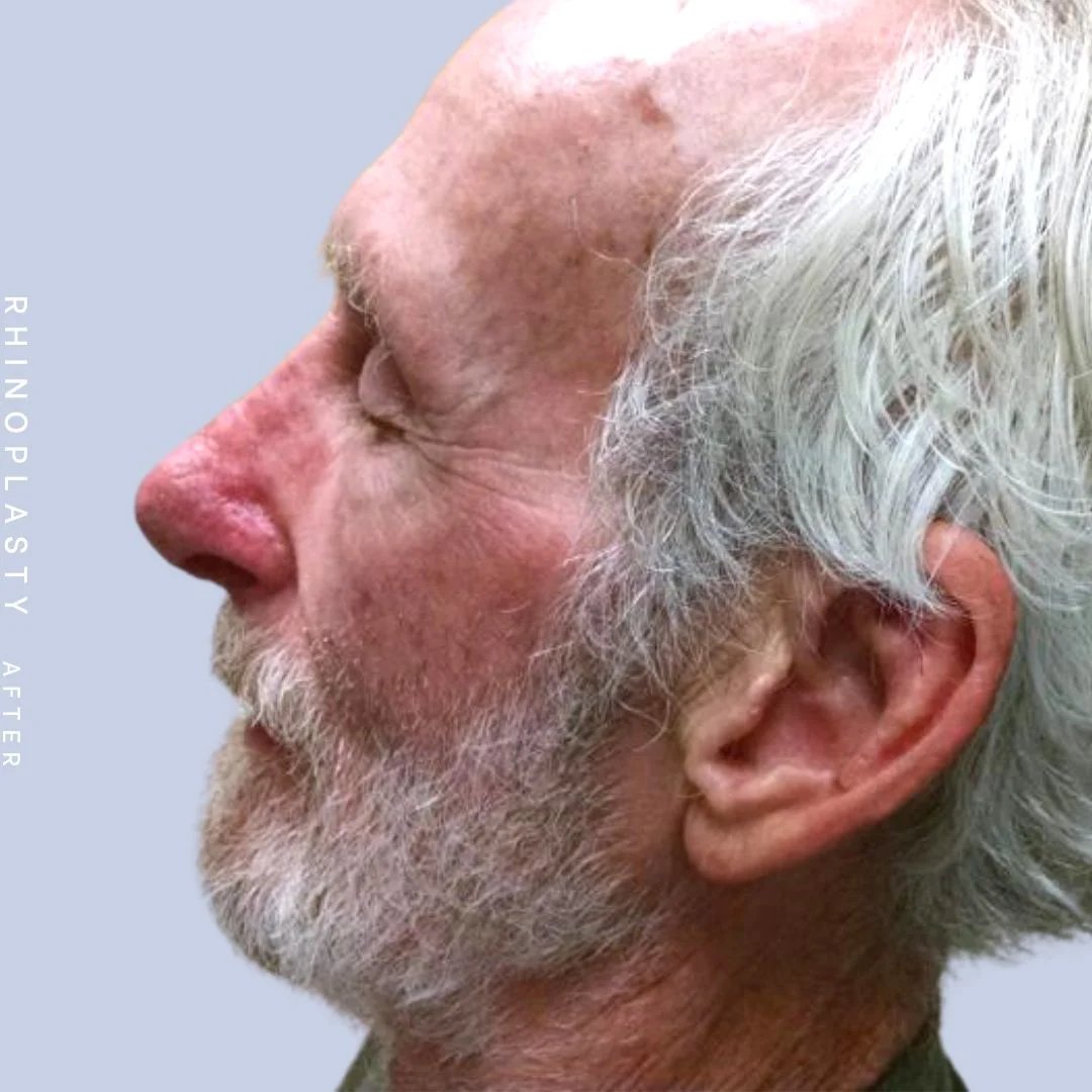 Men's Nose Before & After Gallery - Patient 121123753 - Image 6