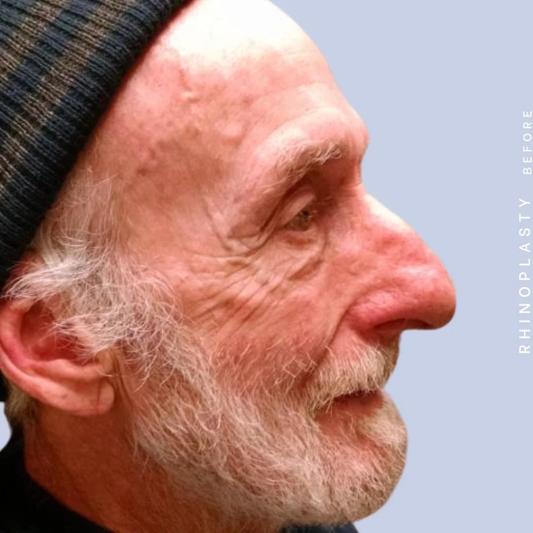 Men's Nose Before & After Gallery - Patient 121123753 - Image 7