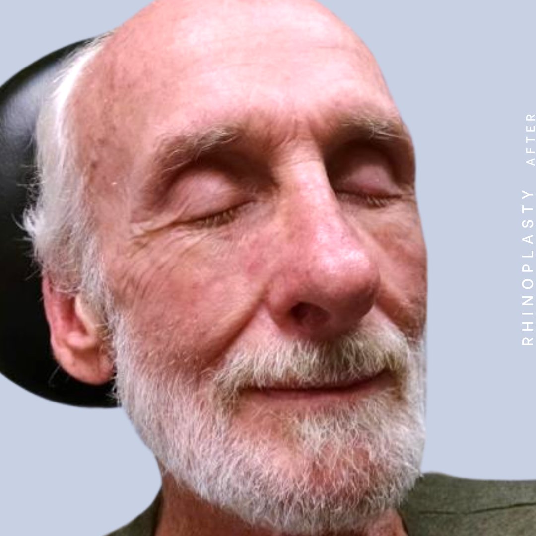 Men's Nose Before & After Gallery - Patient 121123753 - Image 10