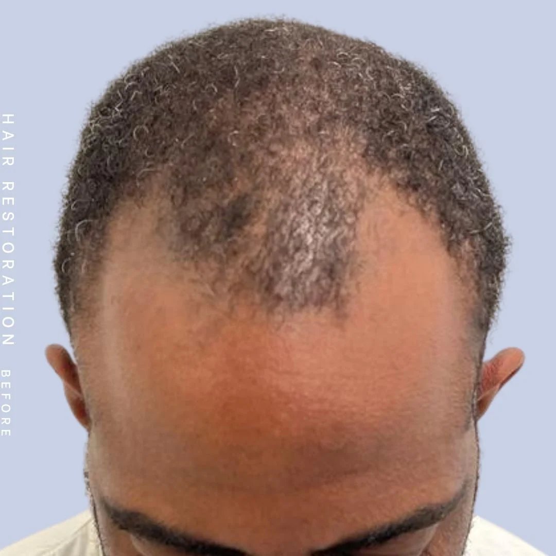 Hair Restoration Before & After Gallery - Patient 121417575 - Image 1