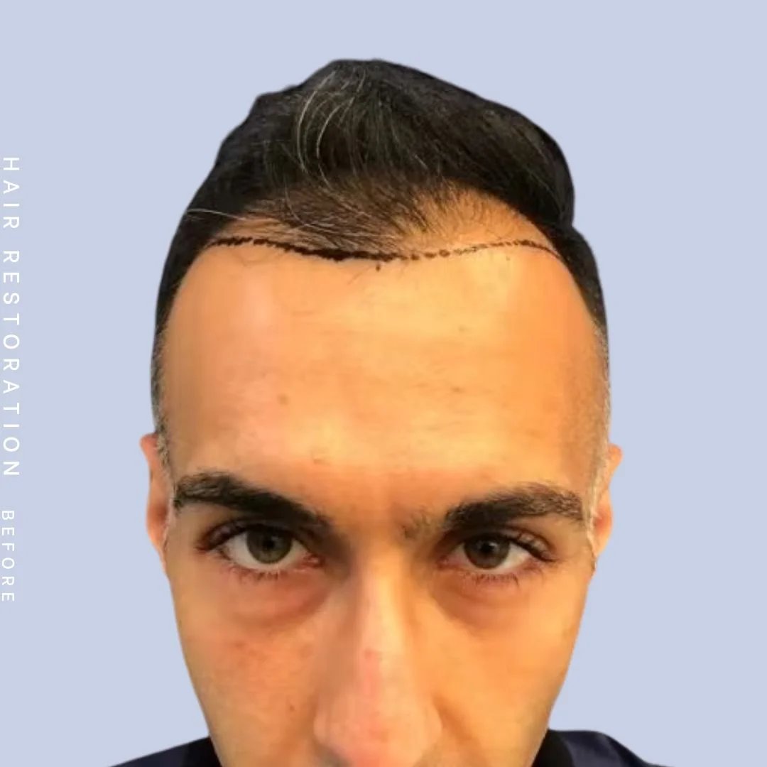 Hair Restoration Before & After Gallery - Patient 121417576 - Image 1