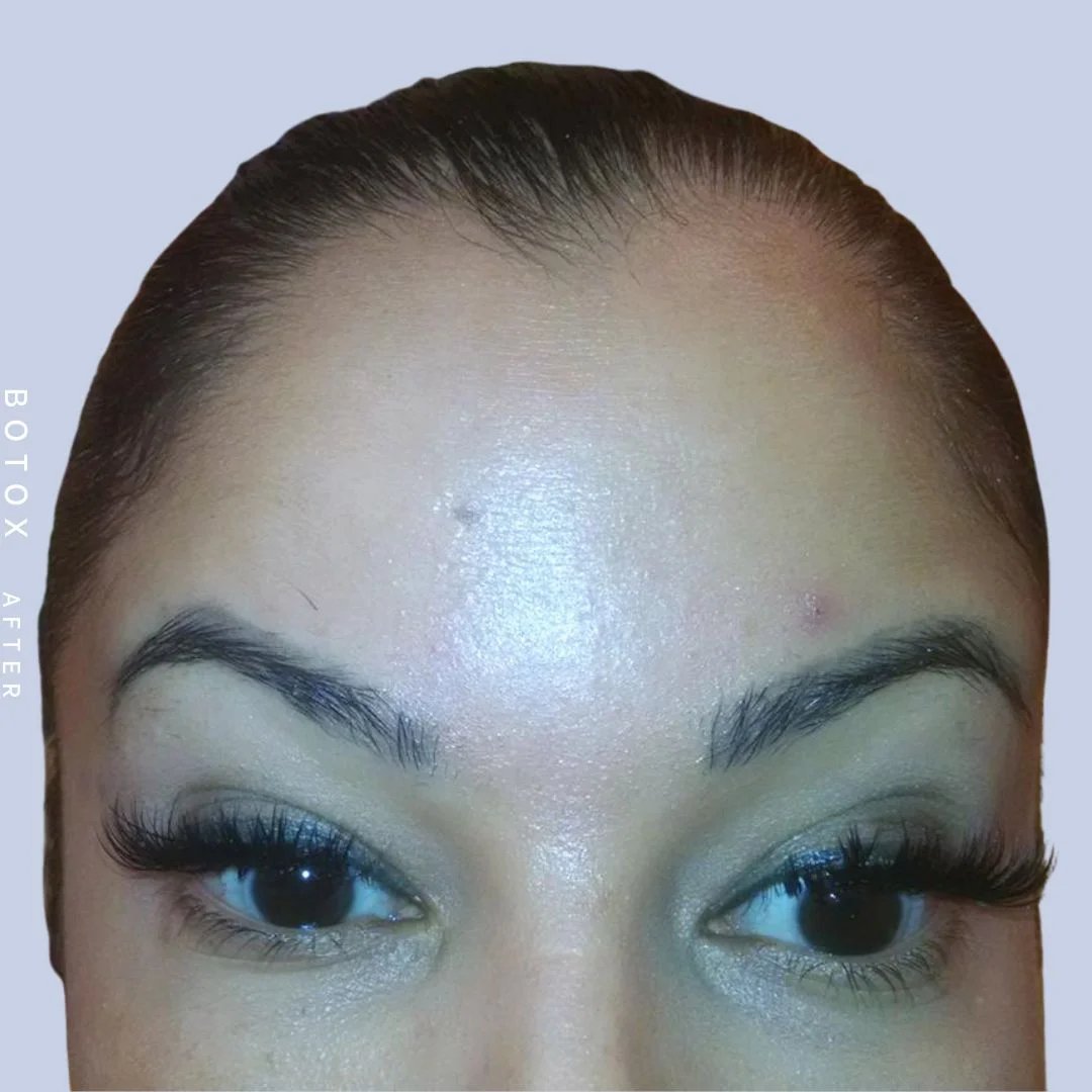 Wrinkles Before & After Gallery - Patient 108744900 - Image 2