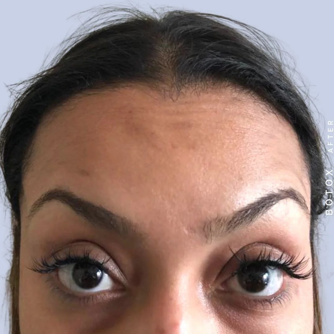 Wrinkles Before & After Gallery - Patient 121122015 - Image 2