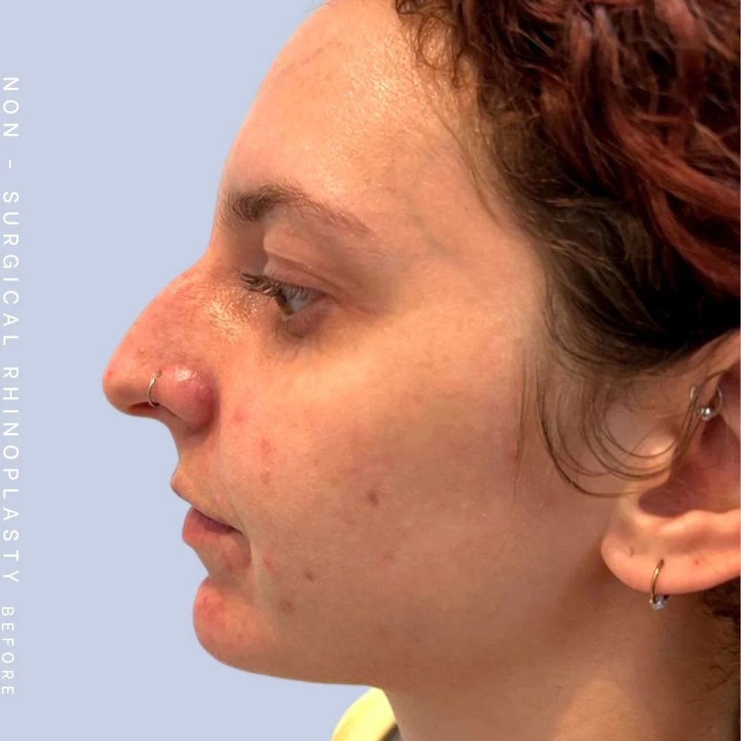 Non-Surgical Nose Before & After Gallery - Patient 122852138 - Image 1