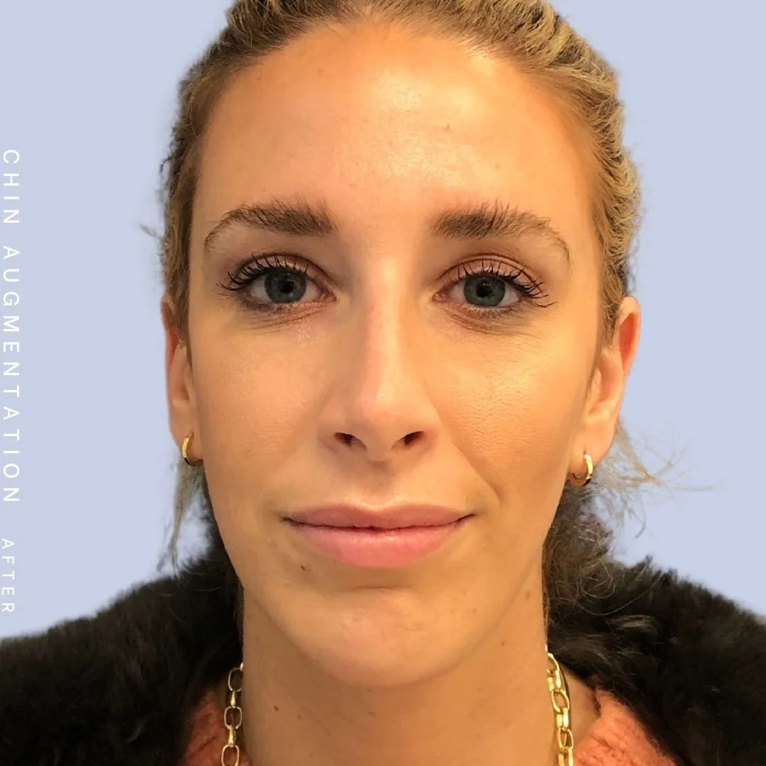 Non-Surgical Nose Before & After Gallery - Patient 108744867 - Image 2