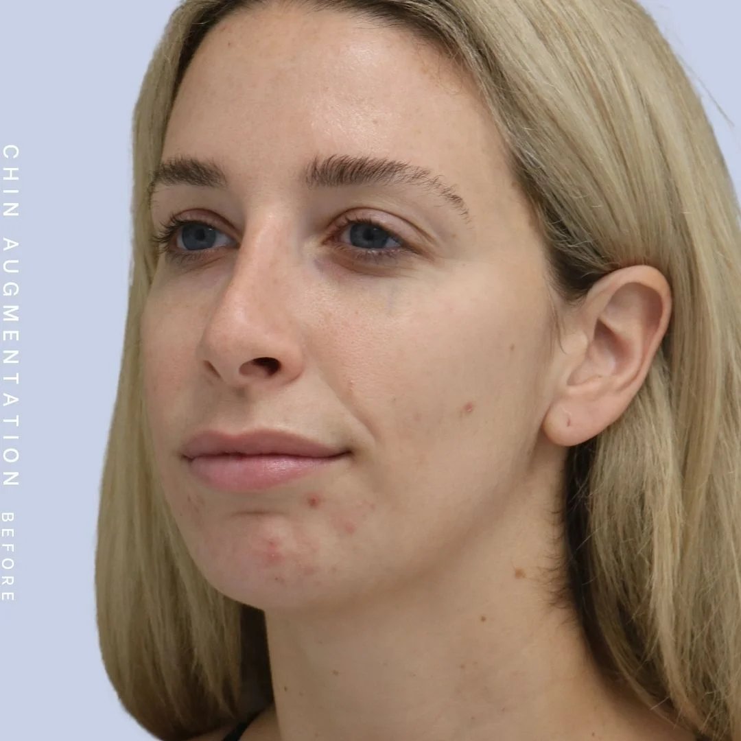 Non-Surgical Nose Before & After Gallery - Patient 108744867 - Image 3