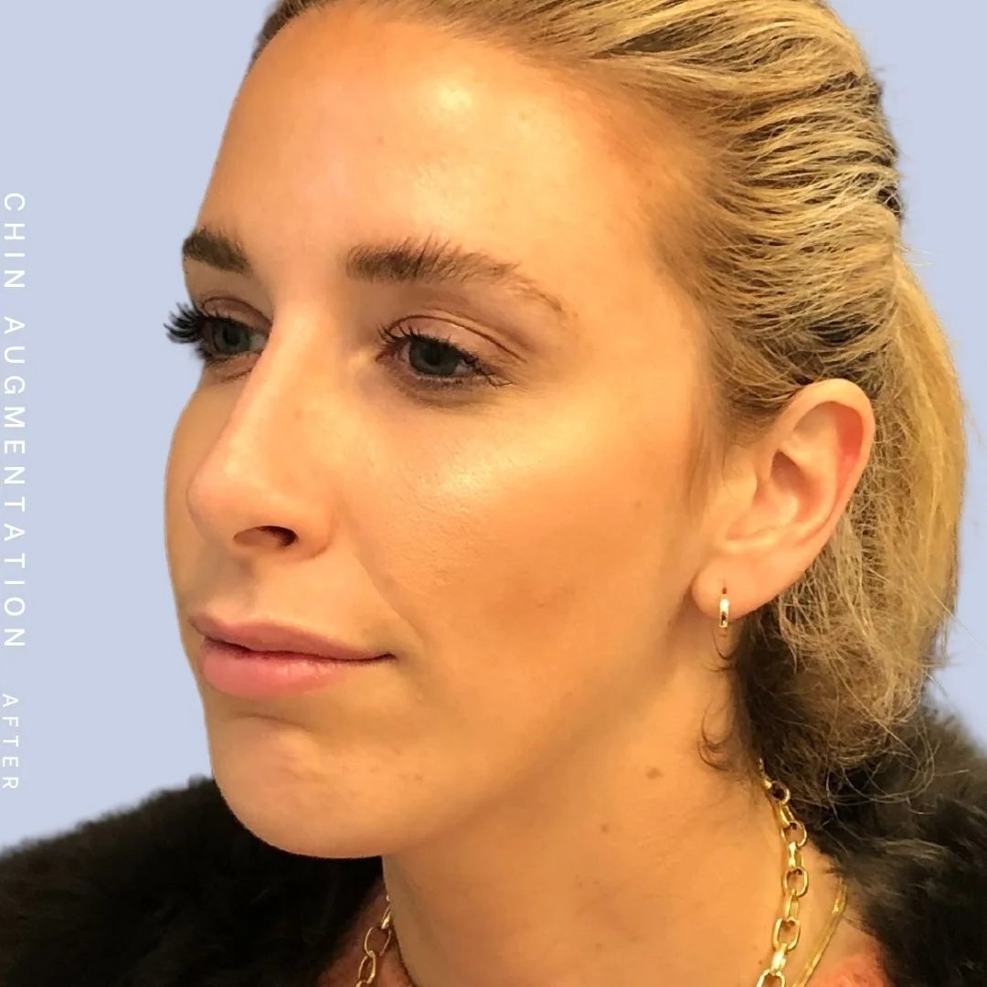 Non-Surgical Nose Before & After Gallery - Patient 108744867 - Image 4