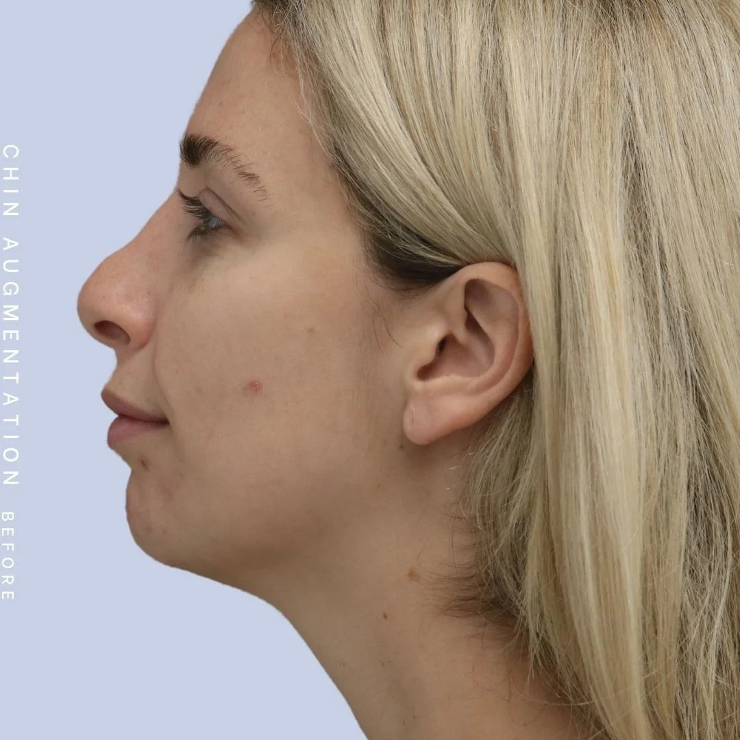 Non-Surgical Nose Before & After Gallery - Patient 108744867 - Image 5