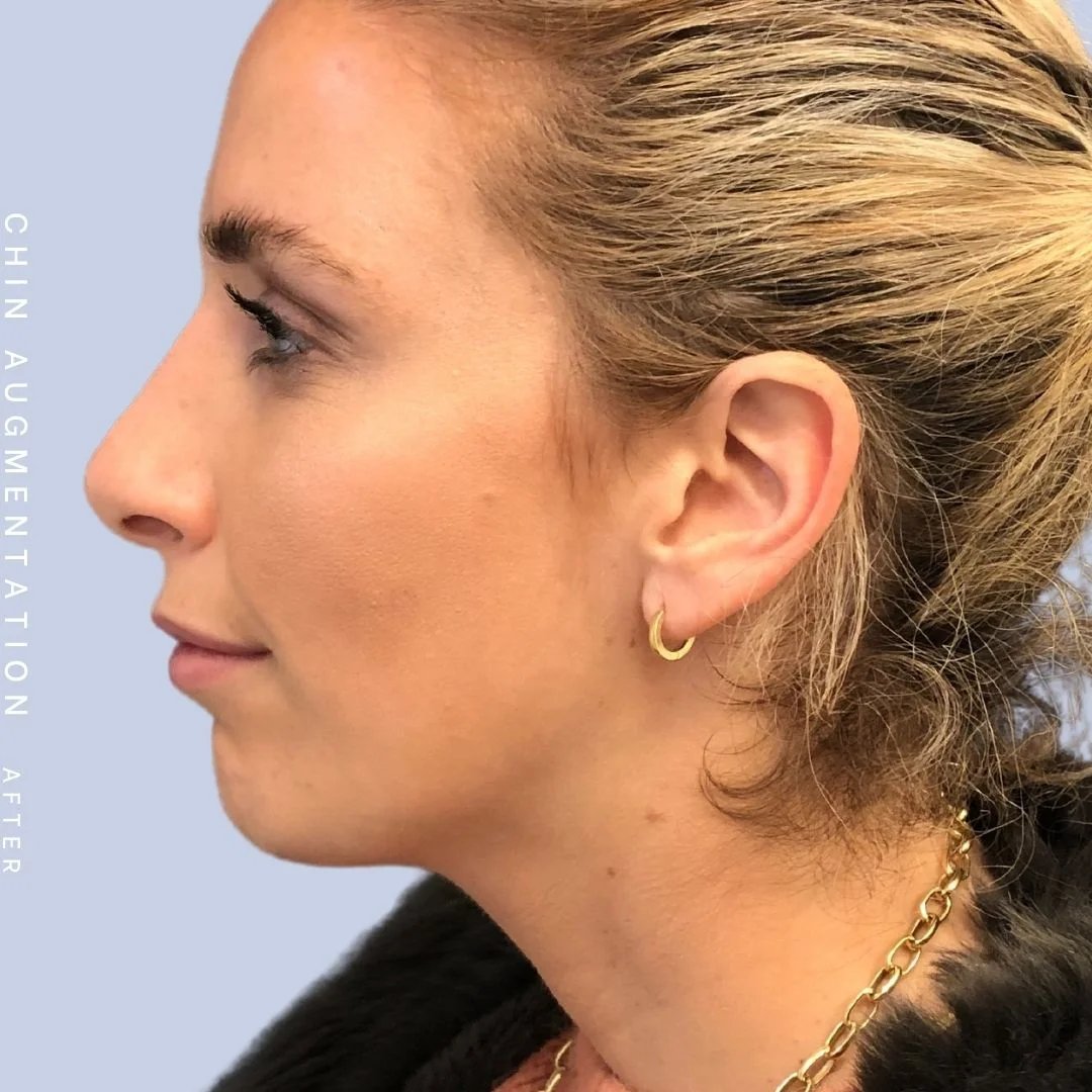 Non-Surgical Nose Before & After Gallery - Patient 108744867 - Image 6
