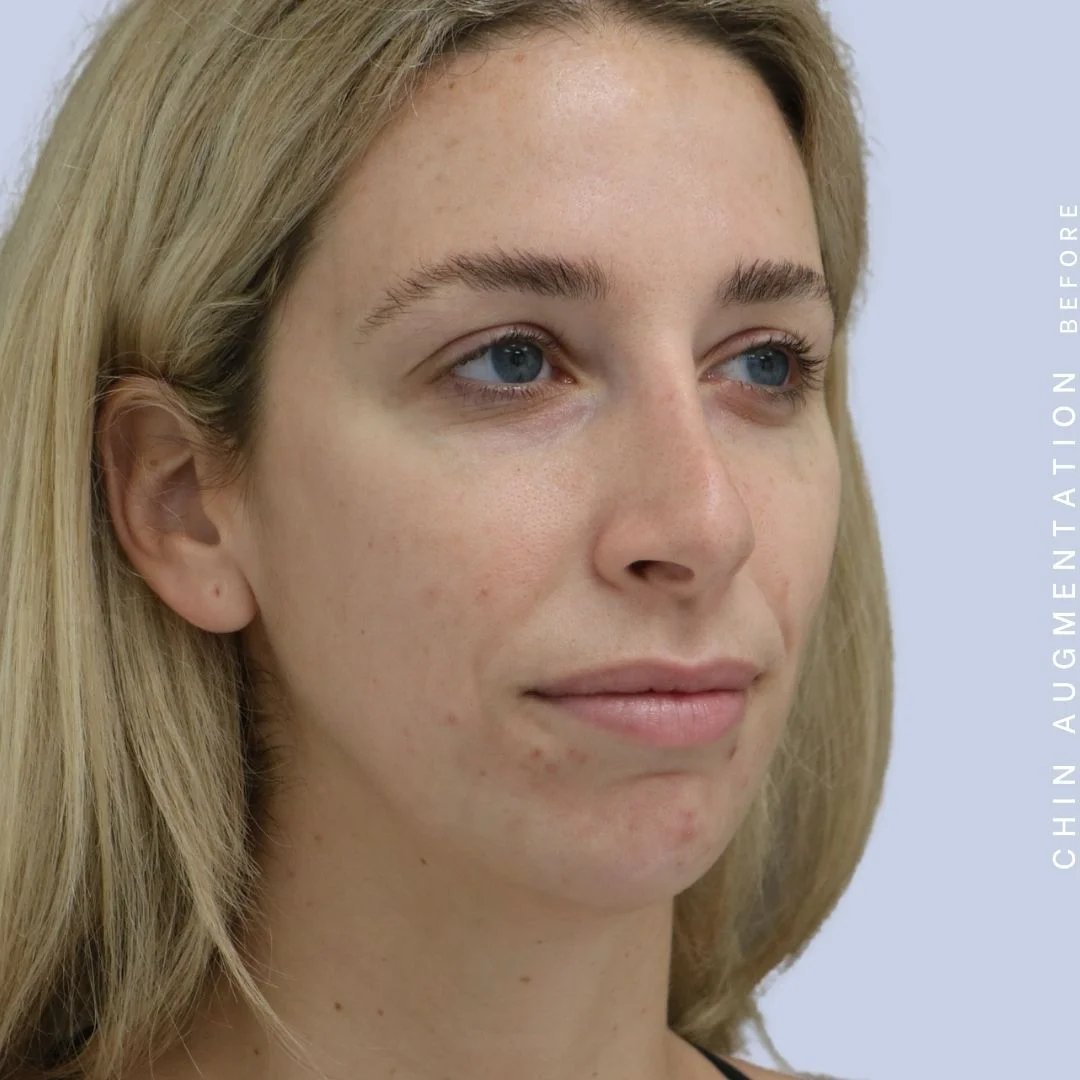 Non-Surgical Nose Before & After Gallery - Patient 108744867 - Image 7