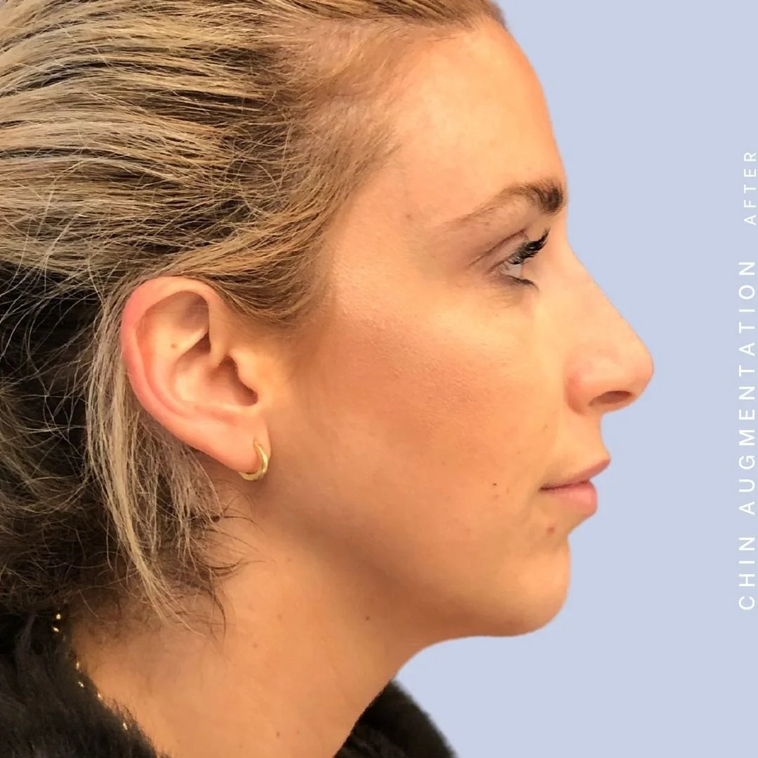 Non-Surgical Nose Before & After Gallery - Patient 108744867 - Image 10