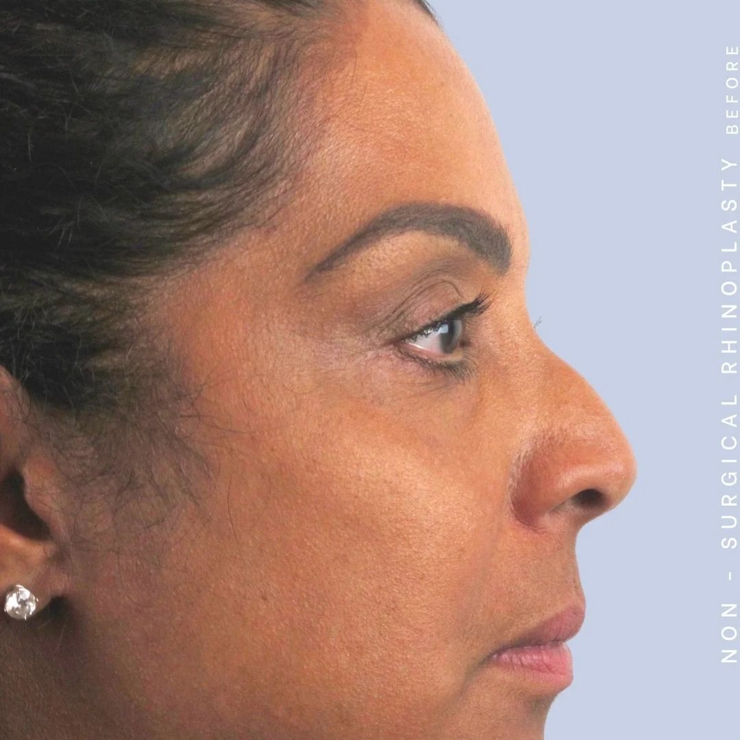 Non-Surgical Nose Before & After Gallery - Patient 108744869 - Image 3