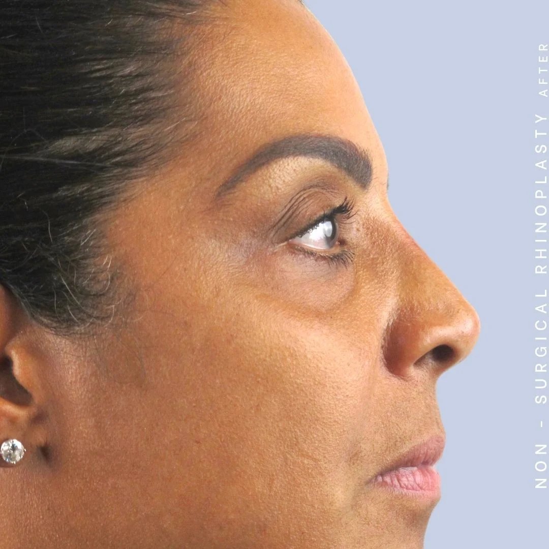 Non-Surgical Nose Before & After Gallery - Patient 108744869 - Image 4