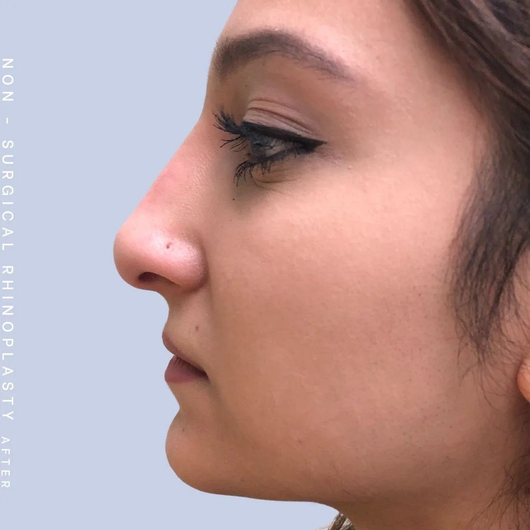 Non-Surgical Nose Before & After Gallery - Patient 108744870 - Image 2
