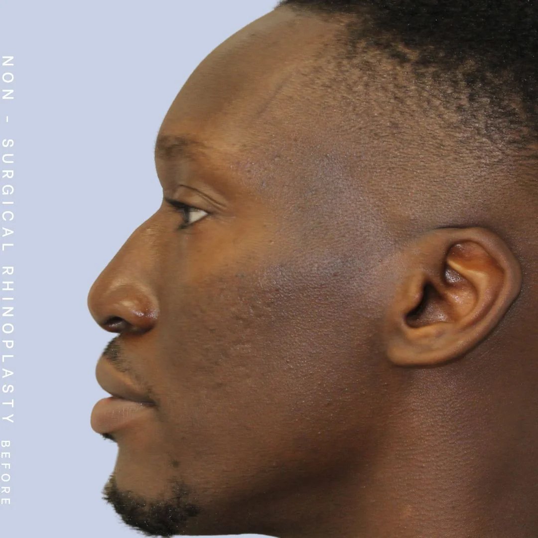 Non-Surgical Nose Before & After Gallery - Patient 108744871 - Image 1