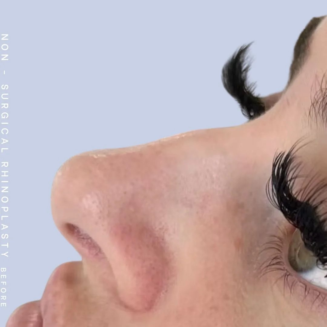 Non-Surgical Nose Before & After Gallery - Patient 121563096 - Image 1