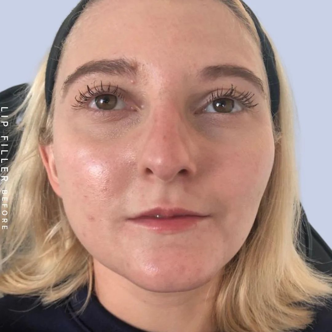 Non-Surgical Lips Before & After Gallery - Patient 121418559 - Image 1