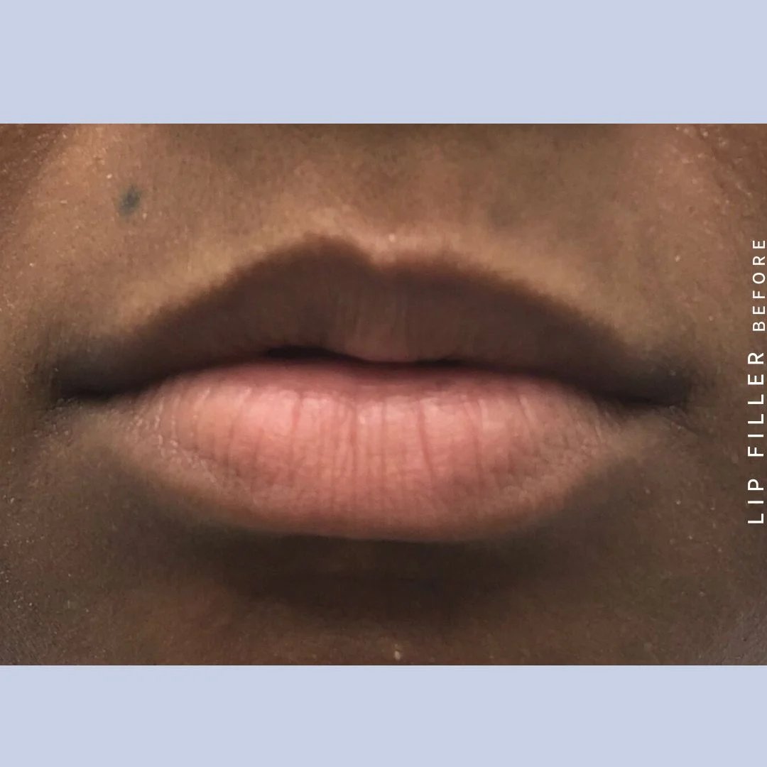 Non-Surgical Lips Before & After Gallery - Patient 108744406 - Image 1