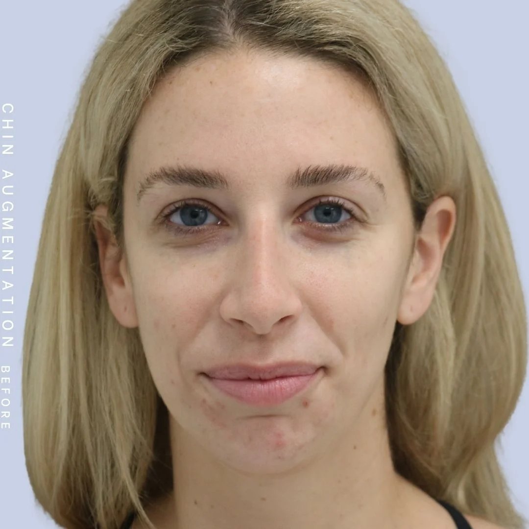 Chin Before & After Gallery - Patient 108744146 - Image 1
