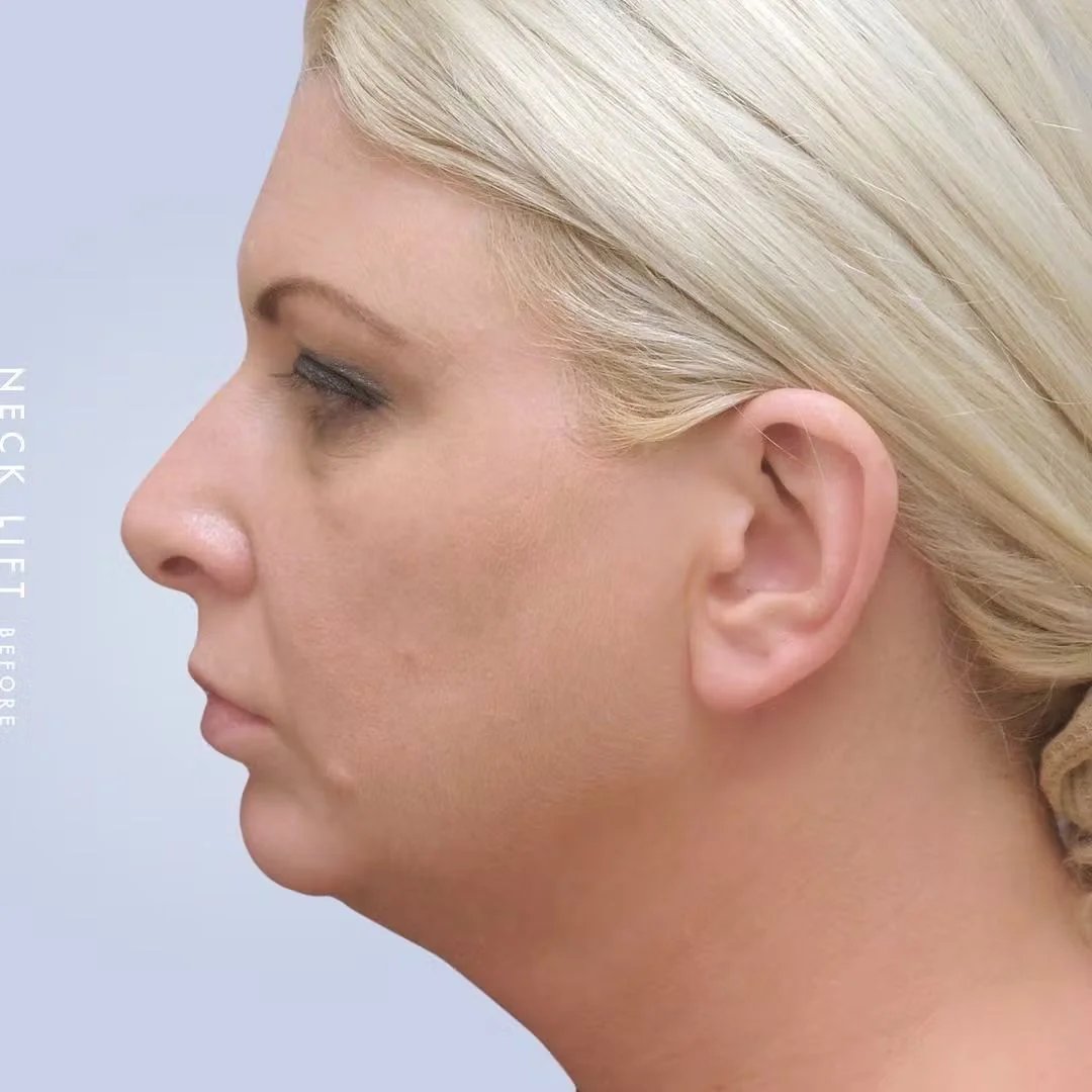 Chin Before & After Gallery - Patient 120145325 - Image 1