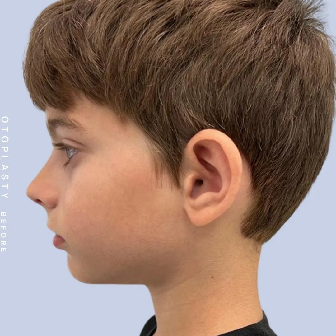 Ears Before & After Gallery - Patient 122542485 - Image 3