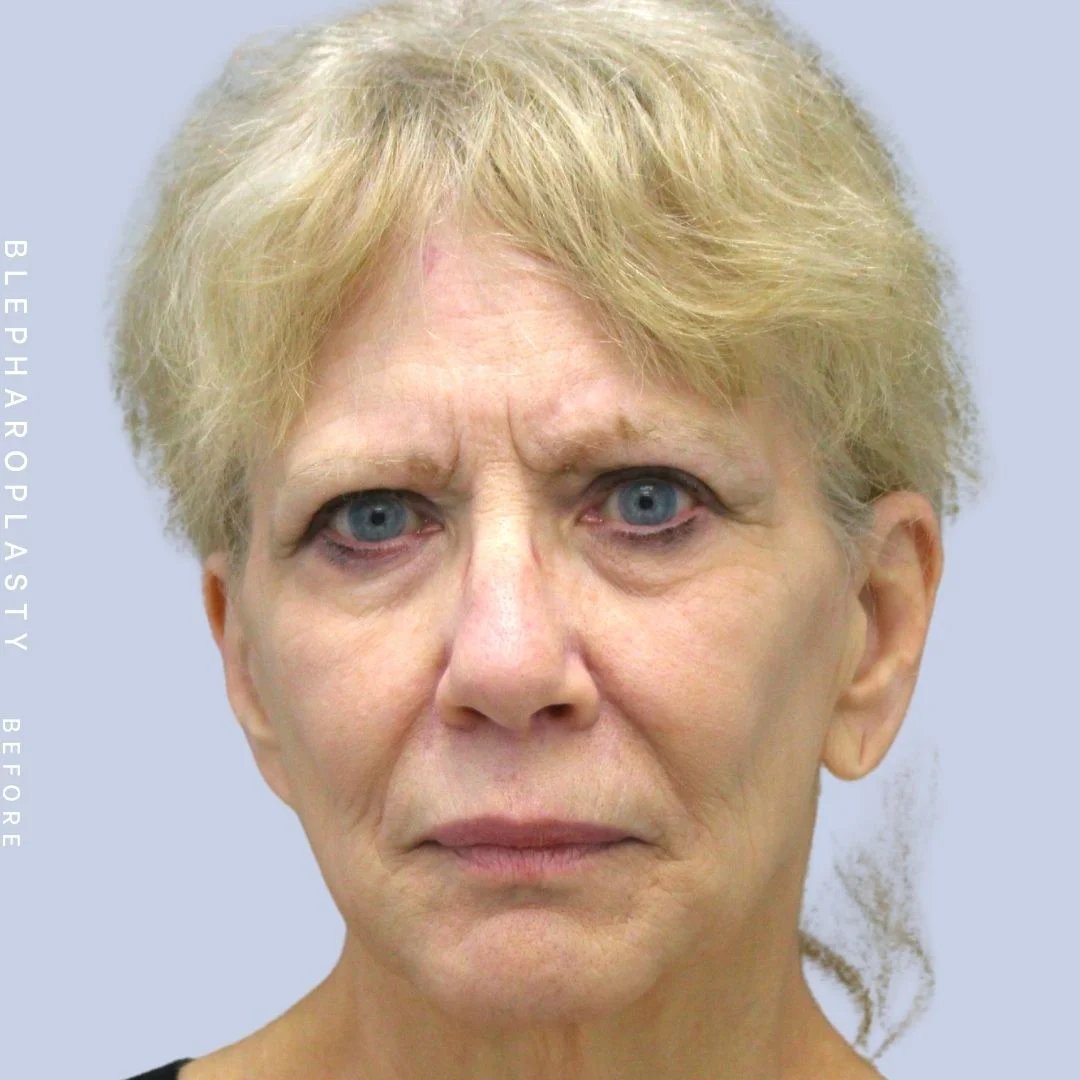 Face & Neck Before & After Gallery - Patient 120868687 - Image 1