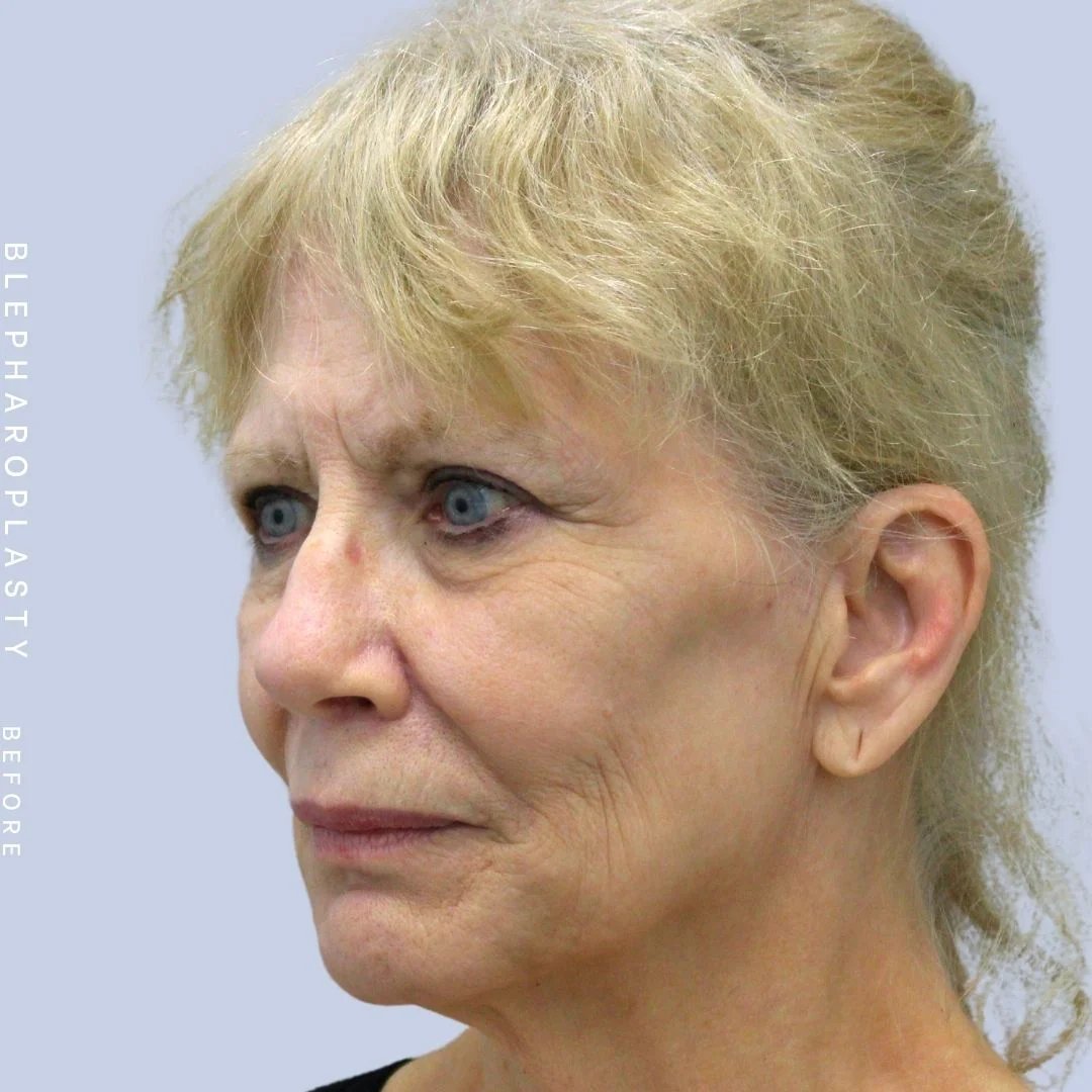 Face & Neck Before & After Gallery - Patient 120868687 - Image 3